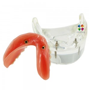  Mandibular Overdenture Model with 2 Implants 