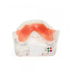  Mandibular Overdenture Model with 2 Implants 