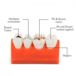 iDENTical Caries Model M4013