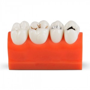 iDENTical Caries Model M4013