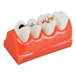 iDENTical Caries Model M4013