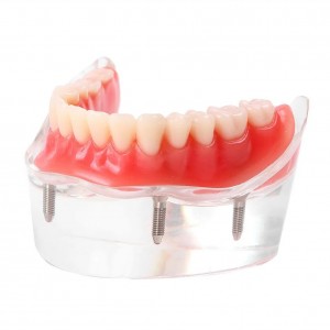  Mandibular Overdenture Model with 4 Implants 