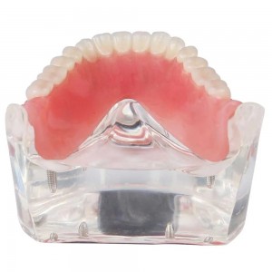  Mandibular Overdenture Model with 4 Implants 