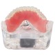  Mandibular Overdenture Model with 4 Implants 