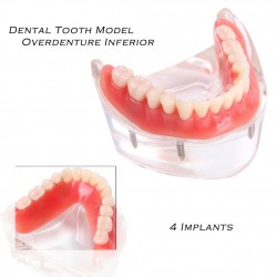  Mandibular Overdenture Model with 4 Implants 